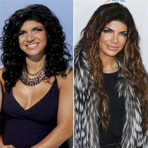 Teresa Giudice Plastic Surgery Photos: Before and After